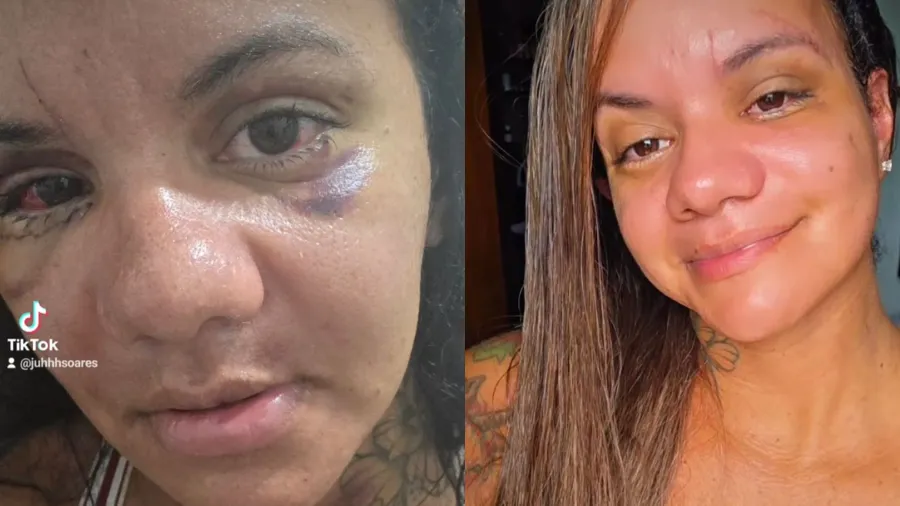 Juliana Soares exibe evolução do rosto 30 dias após reconstrução facial - Imagem do artigo