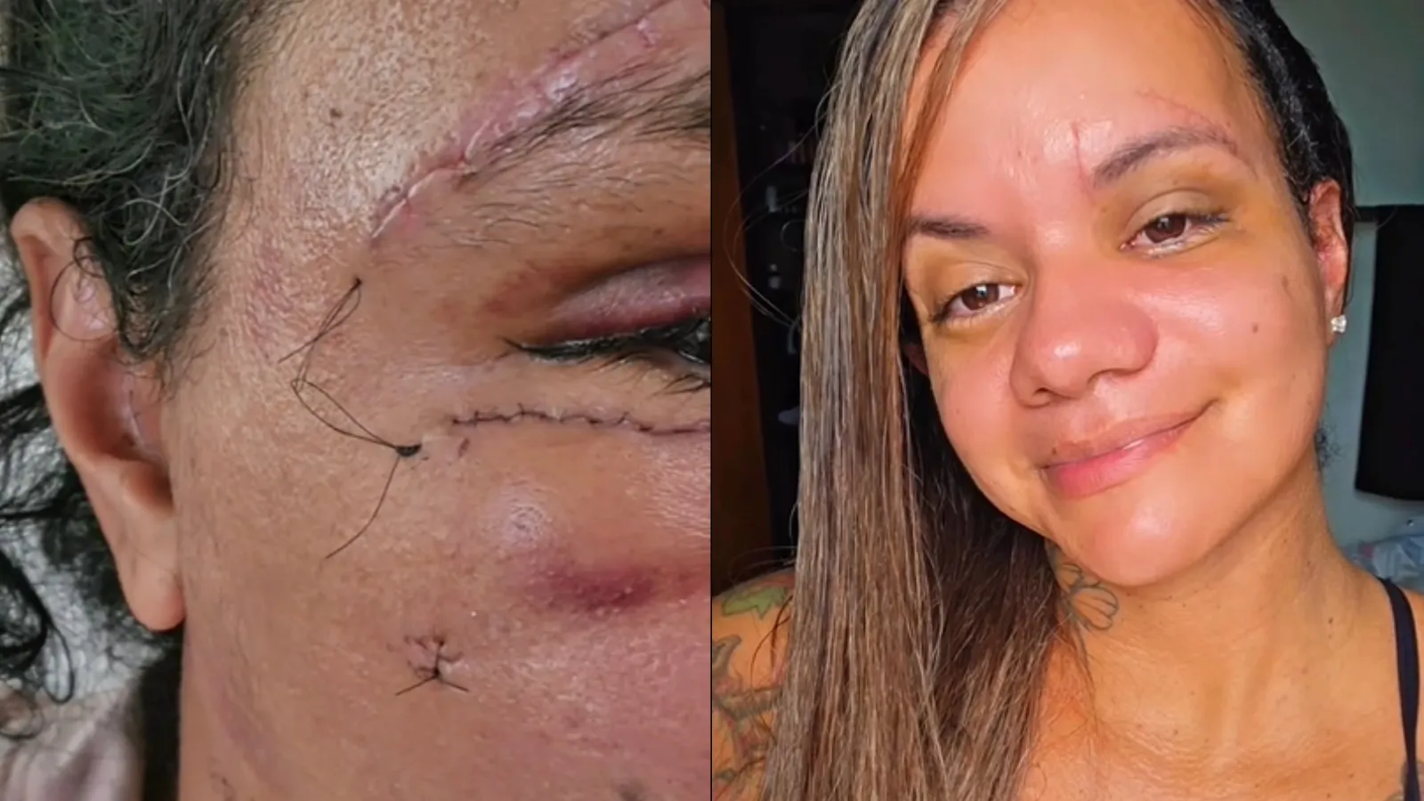 Juliana Soares exibe avanço da reconstrução facial após agressão com 61 socos - Imagem do artigo