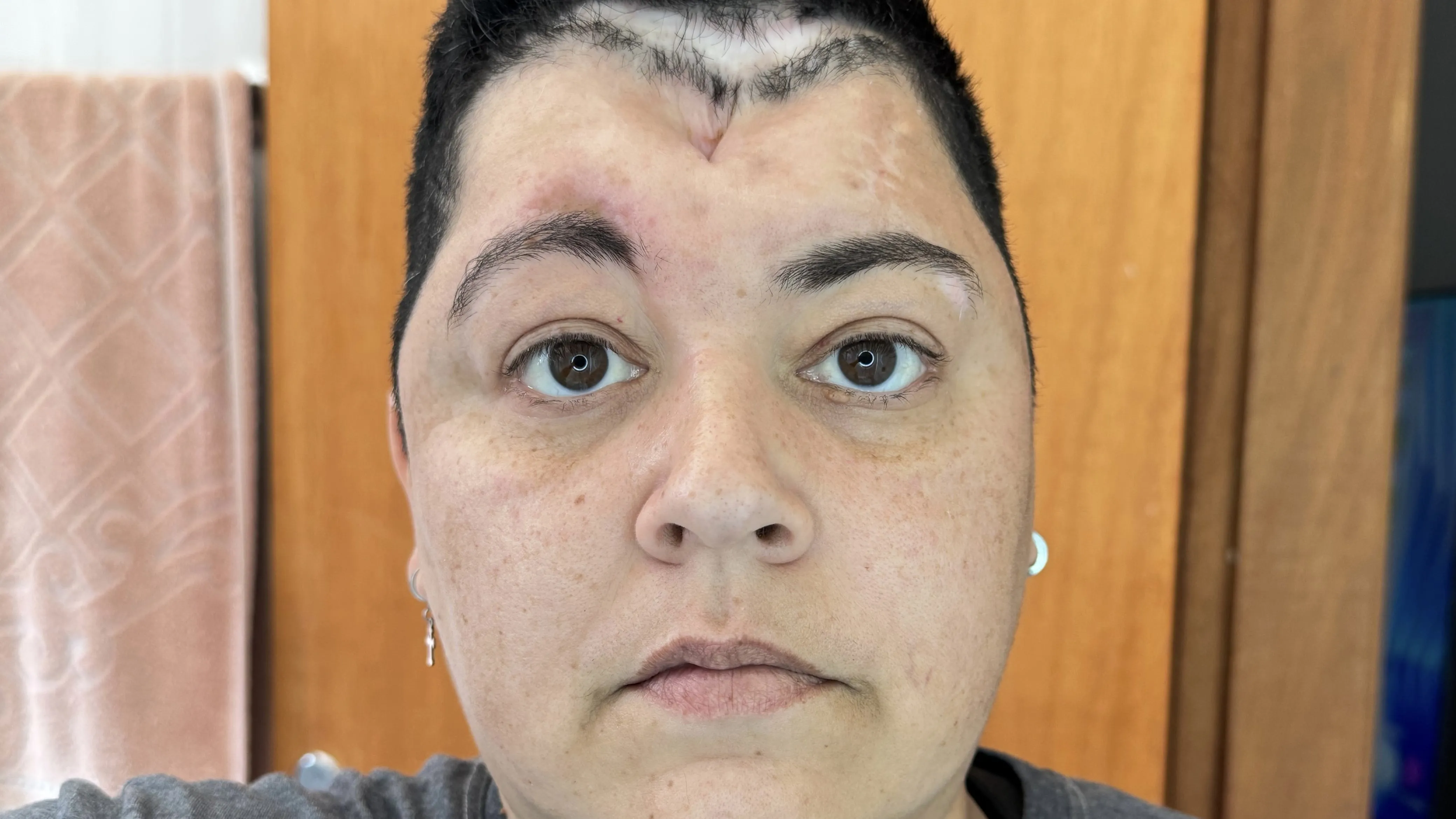 Fístula liquórica: mulher enfrenta sete cirurgias sem cura - Imagem do artigo