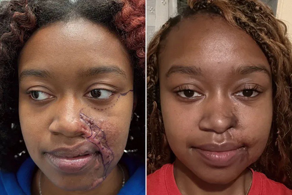 Ataque com ácido: jovem recebe plástica gratuita nos EUA - Imagem do artigo original