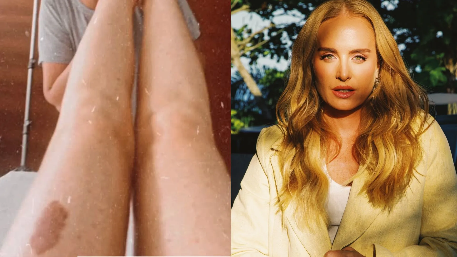 Angélica faz drenagem linfática e exibe famosa pinta - Imagem do artigo