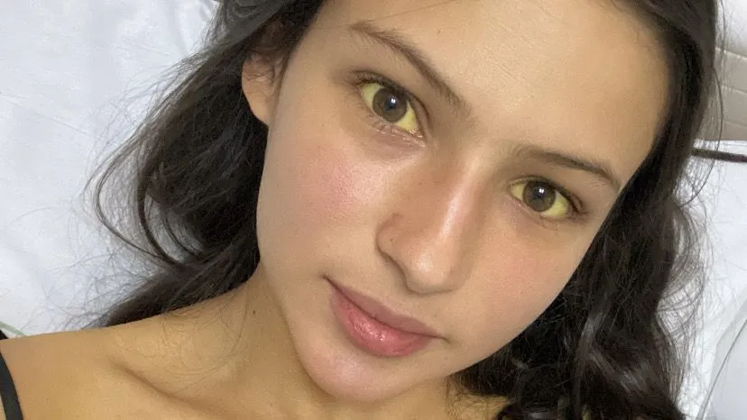 Hepatite medicamentosa: estudante escapa de transplante - Imagem do artigo