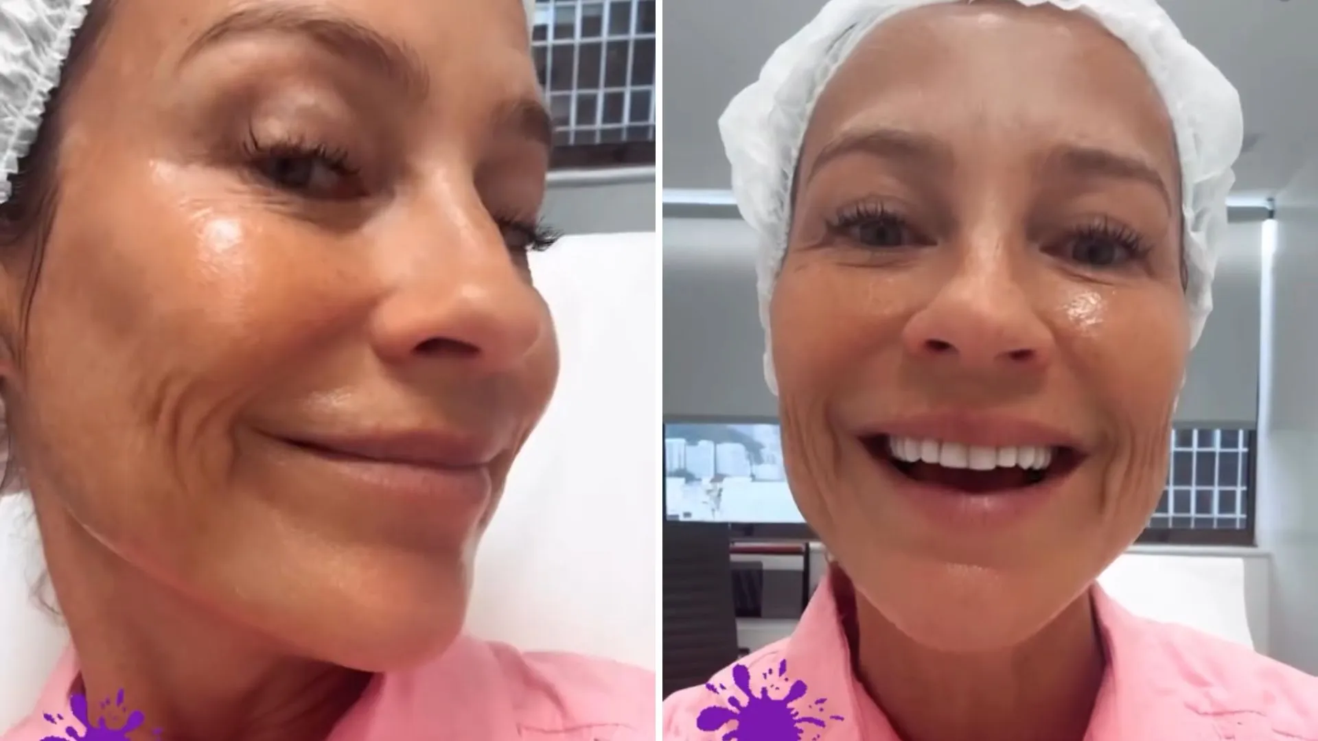 Luana Piovani faz procedimento estético no rosto no Brasil - Imagem do artigo