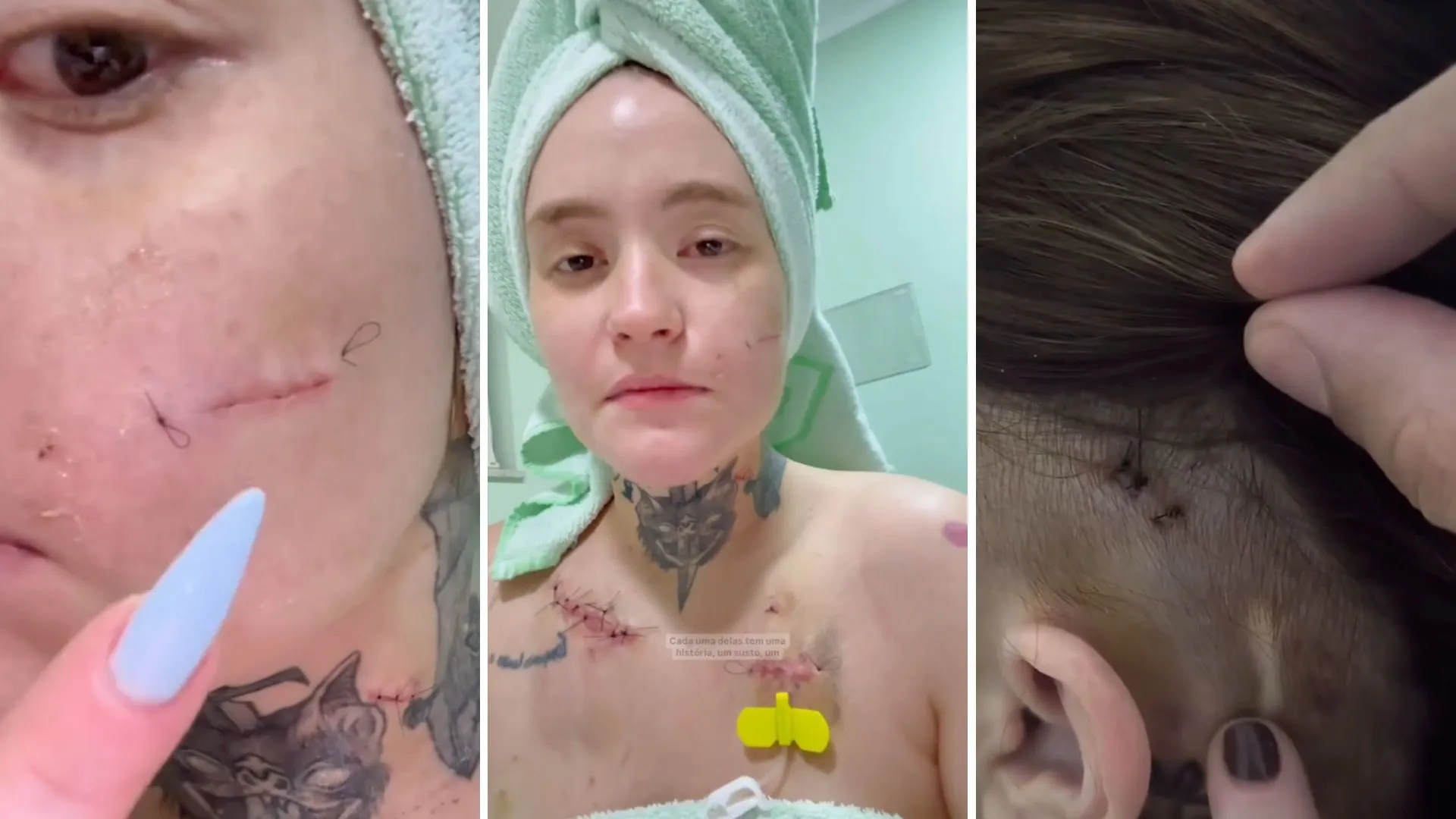 Neuralgia do trigêmeo: cicatrizes e luta de Carolina Arruda - Imagem do artigo