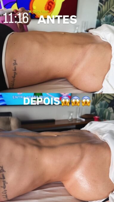 Virginia Fonseca exibe antes e depois de massagem modeladora - Imagem do artigo original