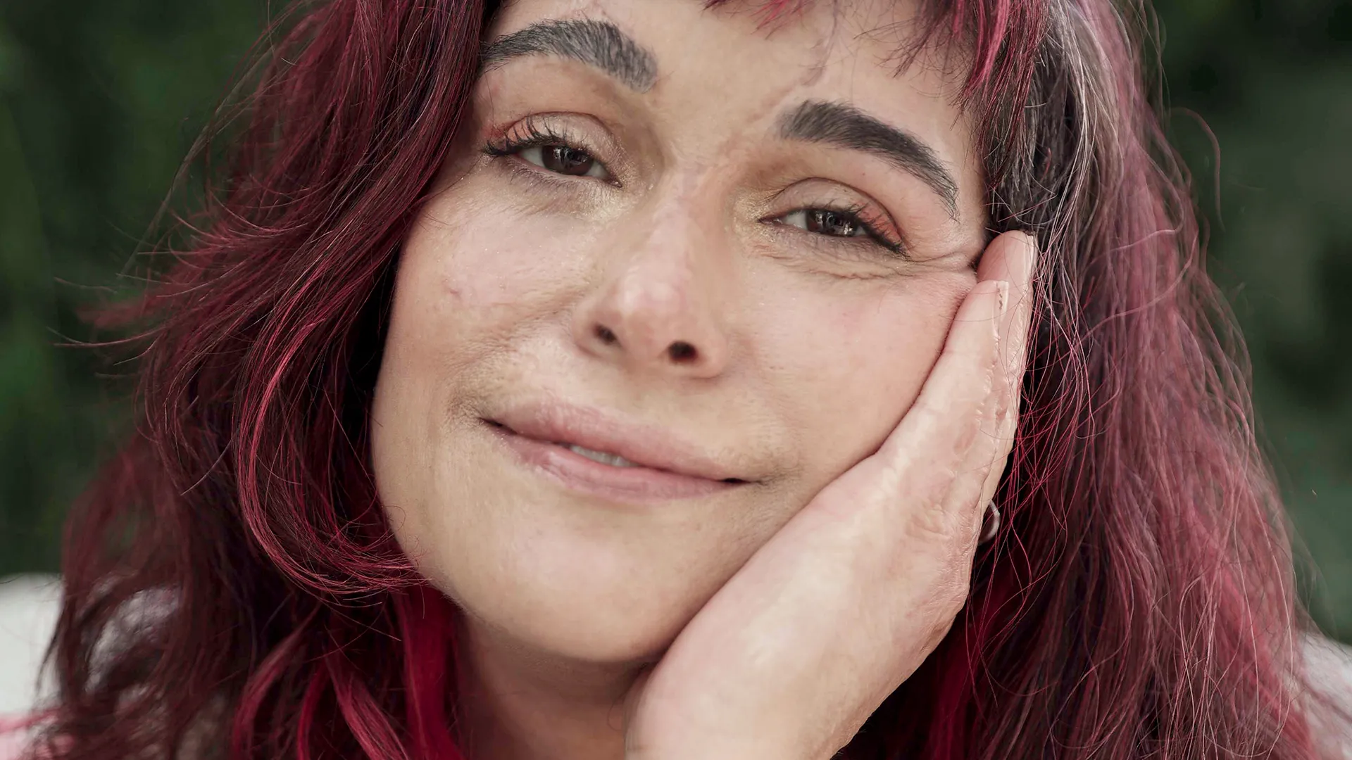 Sobrevivente de incêndio narra renascimento após tragédia - Imagem do artigo