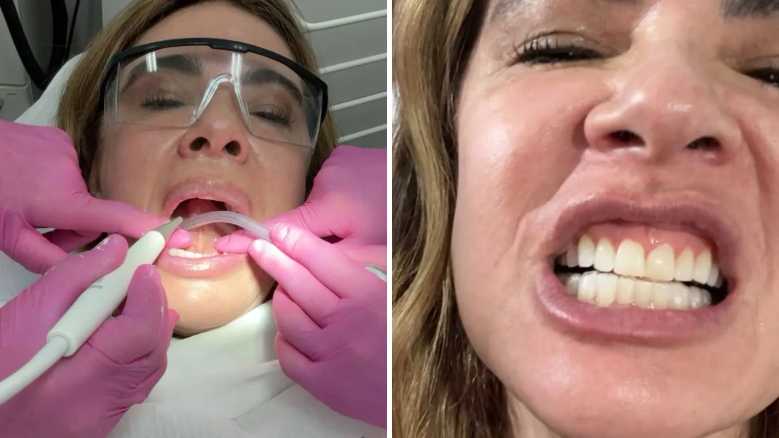 Luciana Gimenez exibe dentes naturais em visita ao dentista - Imagem do artigo