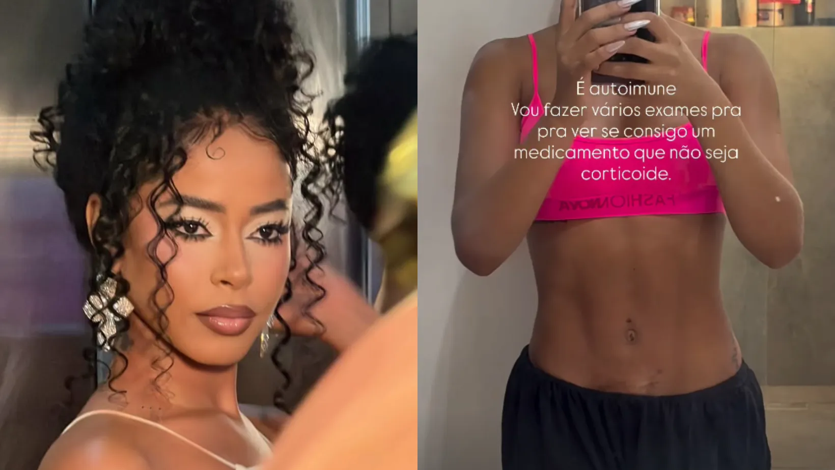 Lorena Maria revela doença autoimune e mostra manchas no corpo - Imagem do artigo