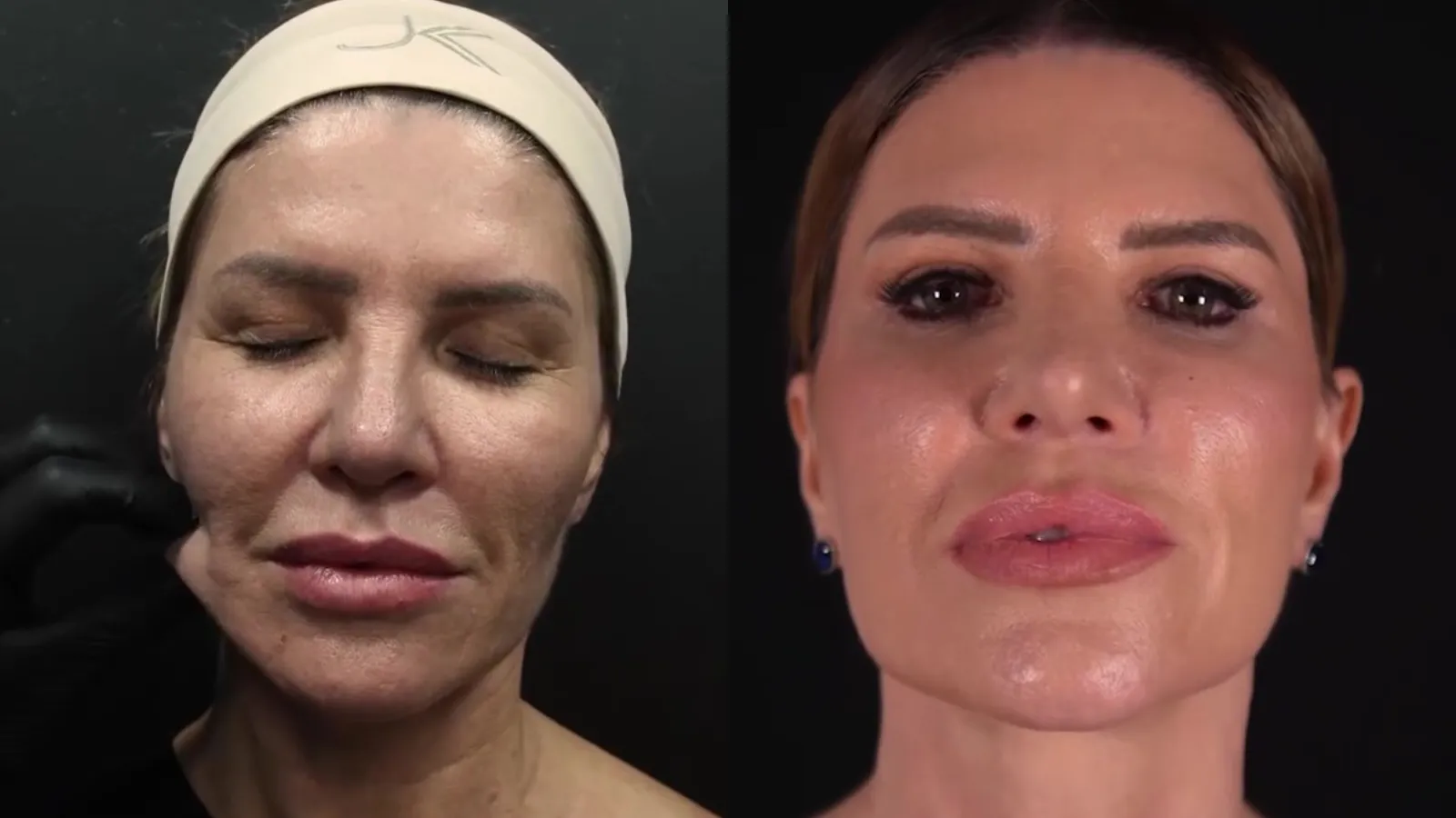 Facelift da mãe de Luísa Sonza exibe resultado natural - Imagem do artigo