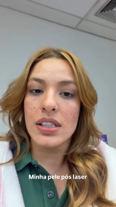 Beatriz Reis sem maquiagem mostra resultado de laser - Imagem do artigo original