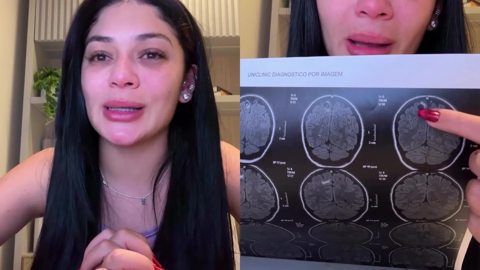 Rayssa Buq relata cura de cisto na cabeça e convulsões - Imagem do artigo