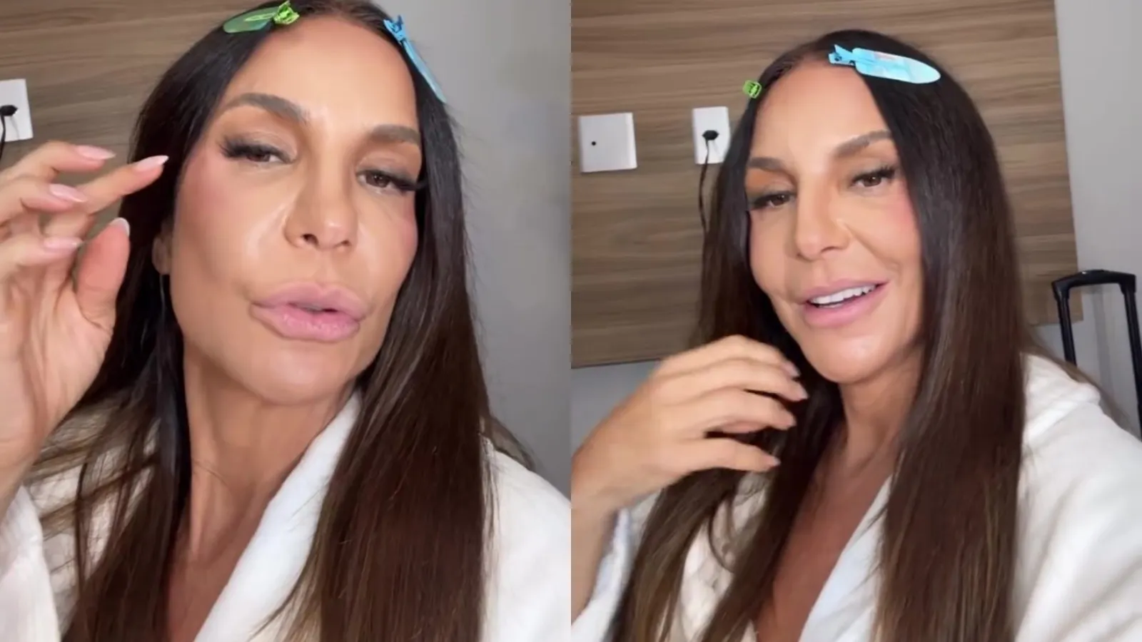 Ivete Sangalo detalha lesão no rosto e recuperação - Imagem do artigo