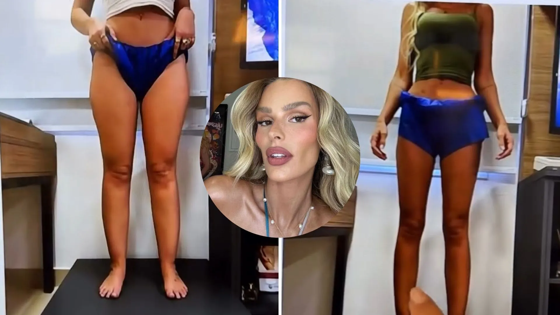 Yasmin Brunet perde 25kg após tratar lipedema - Imagem do artigo