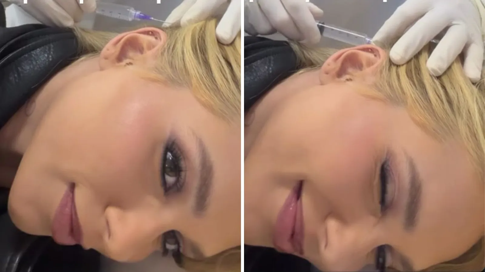 Botox para enxaqueca: Virginia mostra aplicação inédita - Imagem do artigo